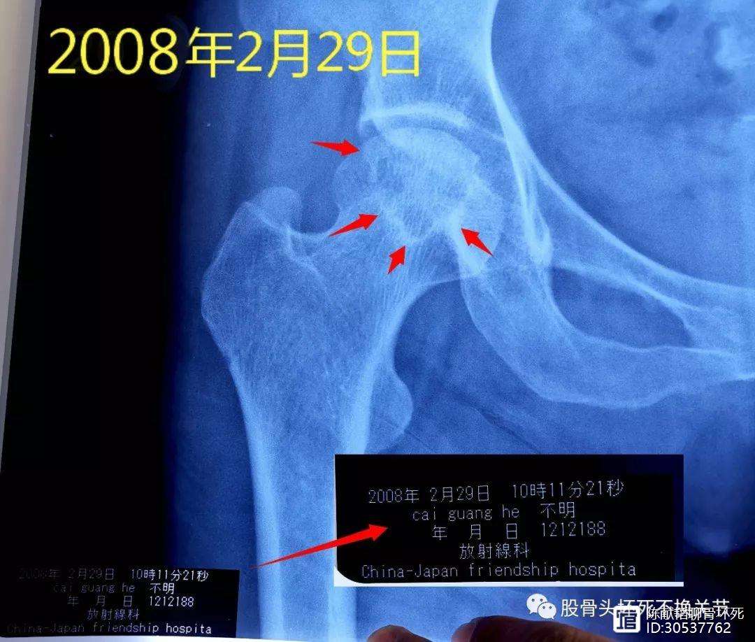 宁德人工骨头医保报销多少(人工骨头医保报销多少比例)
